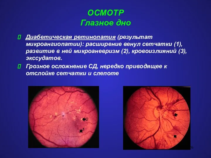 ОСМОТР Глазное дно Диабетическая ретинопатия (результат микроангиопатии): расширение венул сетчатки (1), развитие в