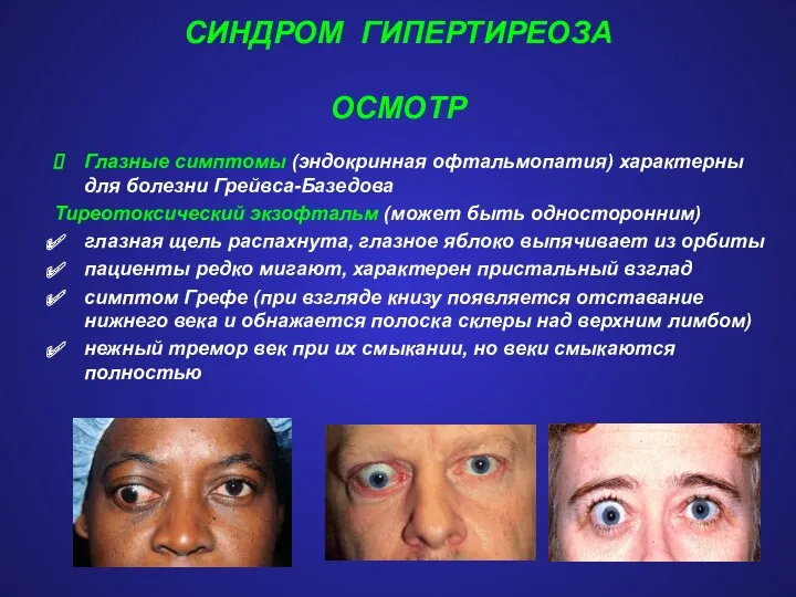 СИНДРОМ ГИПЕРТИРЕОЗА ОСМОТР Глазные симптомы (эндокринная офтальмопатия) характерны для болезни Грейвса-Базедова Тиреотоксический экзофтальм