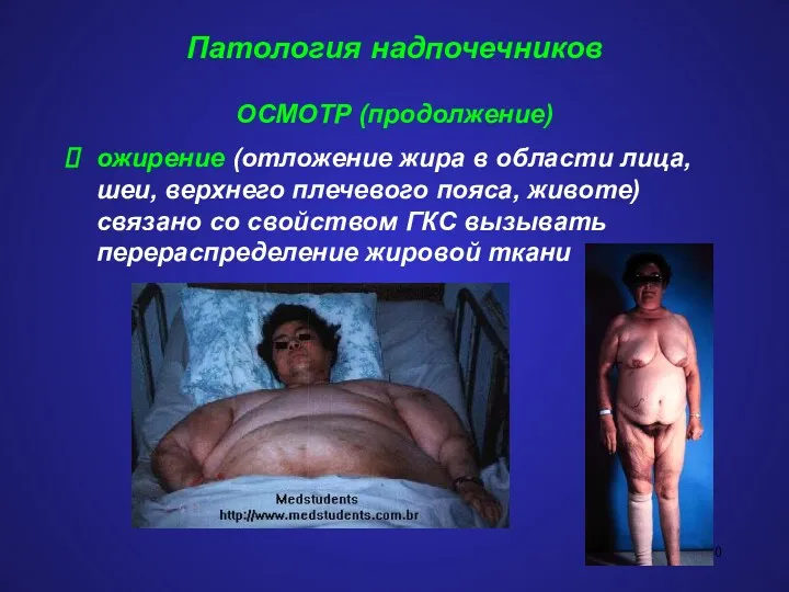 Патология надпочечников ОСМОТР (продолжение) ожирение (отложение жира в области лица, шеи, верхнего плечевого