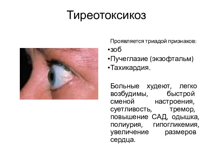 Тиреотоксикоз Проявляется триадой признаков: зоб Пучеглазие (экзофтальм) Тахикардия. Больные худеют,