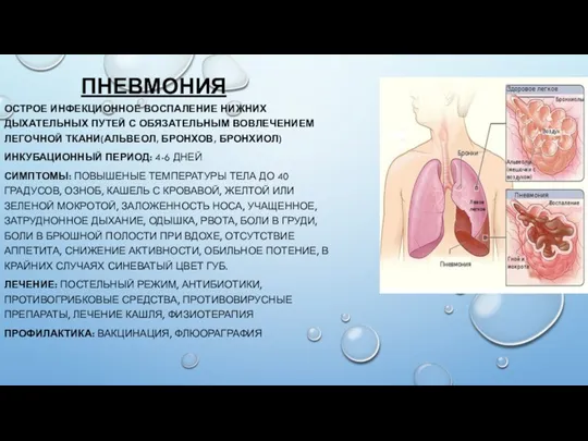 ПНЕВМОНИЯ ОСТРОЕ ИНФЕКЦИОННОЕ ВОСПАЛЕНИЕ НИЖНИХ ДЫХАТЕЛЬНЫХ ПУТЕЙ С ОБЯЗАТЕЛЬНЫМ ВОВЛЕЧЕНИЕМ