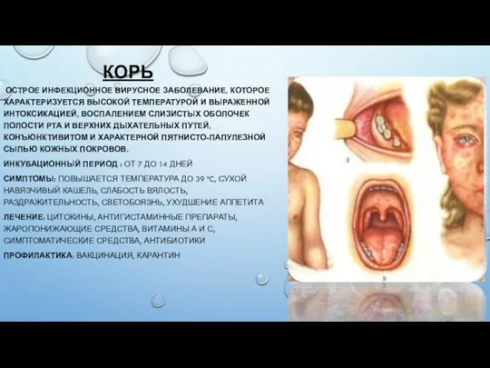 КОРЬ ОСТРОЕ ИНФЕКЦИОННОЕ ВИРУСНОЕ ЗАБОЛЕВАНИЕ, КОТОРОЕ ХАРАКТЕРИЗУЕТСЯ ВЫСОКОЙ ТЕМПЕРАТУРОЙ И