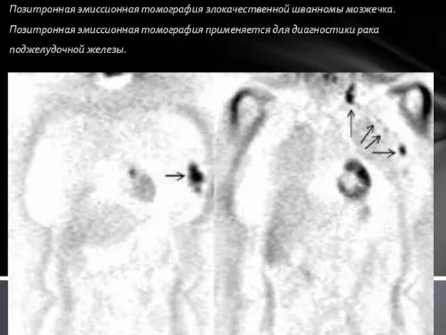 Позитронная эмиссионная томография злокачественной шванномы мозжечка. Позитронная эмиссионная томография применяется для диагностики рака поджелудочной железы.