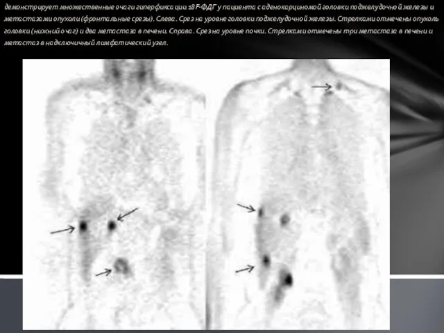 демонстрирует множественные очаги гиперфиксации 18F-ФДГ у пациента с аденокарциномой головки