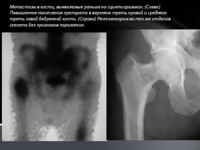 Метастазы в кости, выявляемые раньше на сцинтиграммах. (Слева) Повышенное накопление препарата в верхнюю