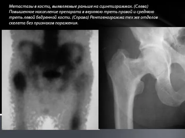 Метастазы в кости, выявляемые раньше на сцинтиграммах. (Слева) Повышенное накопление