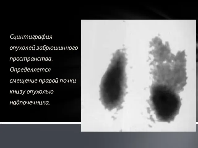 Сцинтиграфия опухолей забрюшинного пространства. Определяется смещение правой почки книзу опухолью надпочечника.