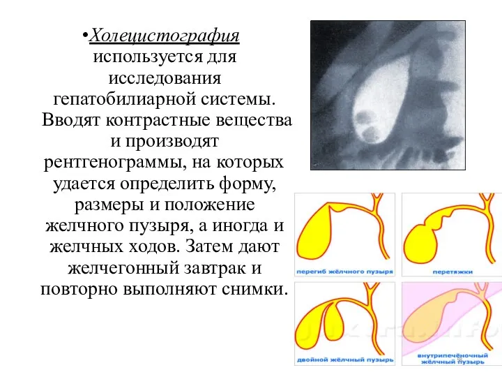 Холецистография используется для исследования гепатобилиарной системы. Вводят контрастные вещества и