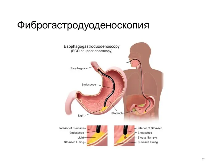 Фиброгастродуоденоскопия