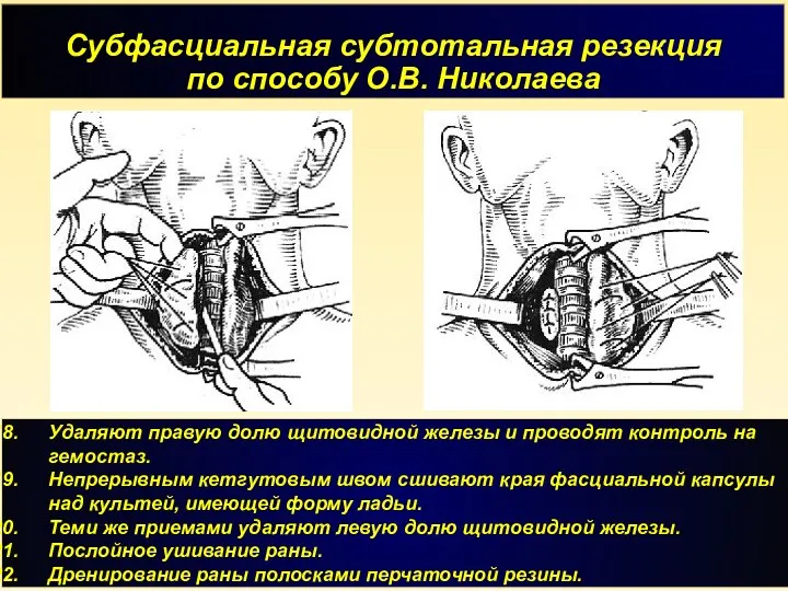 Субфасциальная субтотальная резекция по способу О.В. Николаева Удаляют правую долю щитовидной железы и