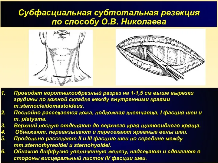 Субфасциальная субтотальная резекция по способу О.В. Николаева Проводят воротникообразный разрез на 1-1,5 см