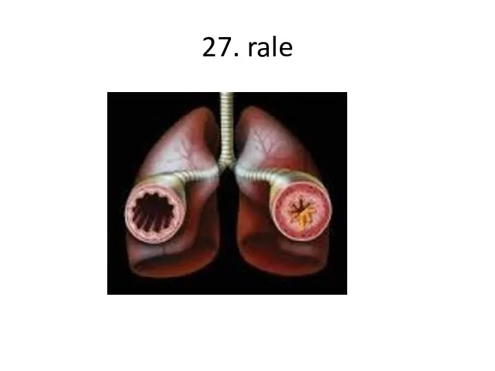 27. rale