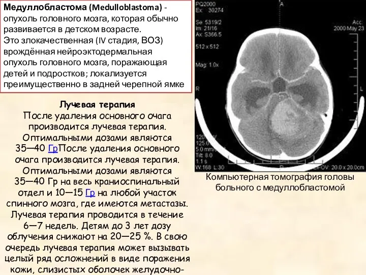 Лучевая терапия После удаления основного очага производится лучевая терапия. Оптимальными