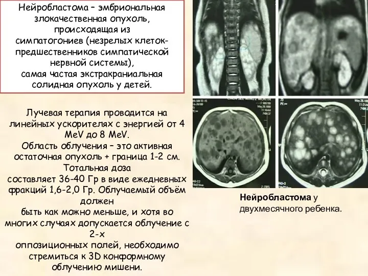 Нейробластома – эмбриональная злокачественная опухоль, происходящая из симпатогониев (незрелых клеток-предшественников