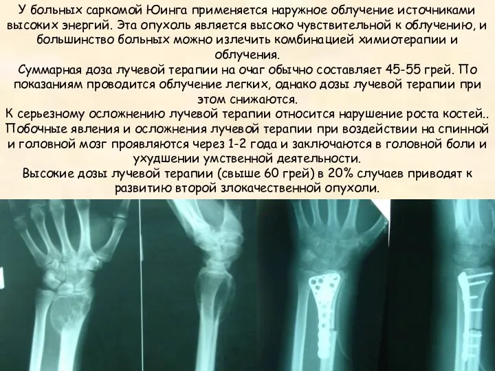 У больных саркомой Юинга применяется наружное облучение источниками высоких энергий. Эта опухоль является