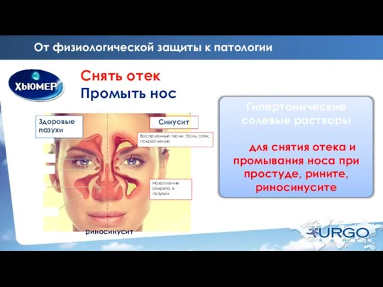 От физиологической защиты к патологии Снять отек Промыть нос Гипертонические