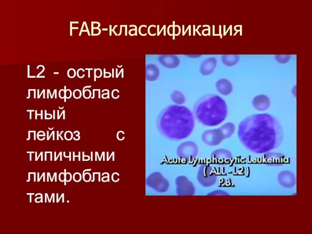 FAB-классификация L2 - острый лимфобластный лейкоз с типичными лимфобластами.