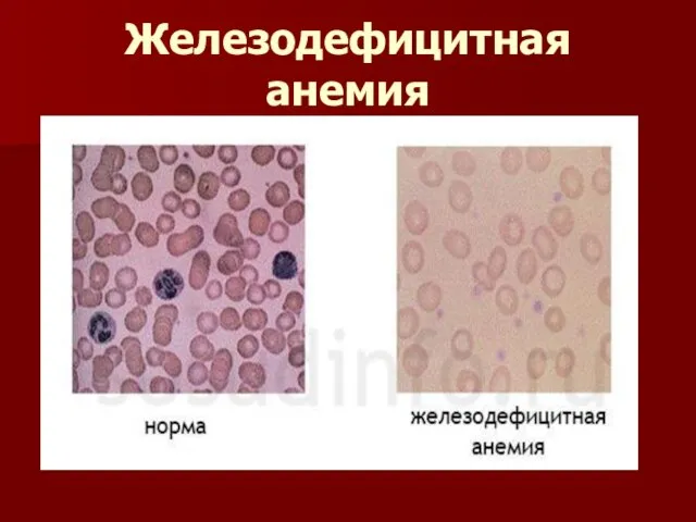 Железодефицитная анемия