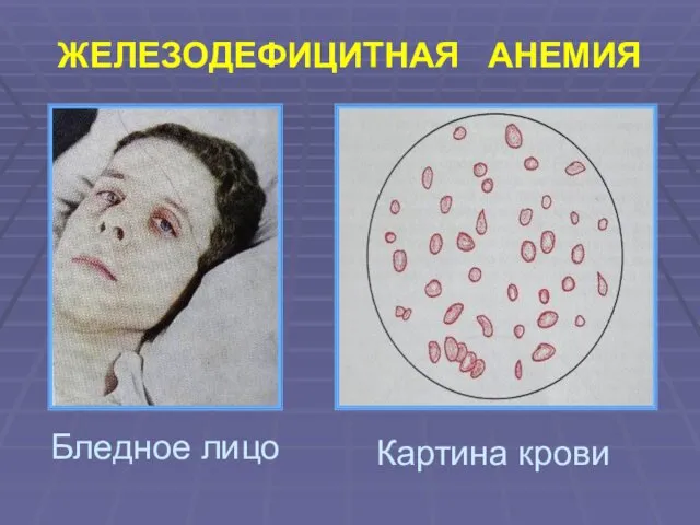 Бледное лицо Картина крови ЖЕЛЕЗОДЕФИЦИТНАЯ АНЕМИЯ