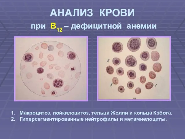АНАЛИЗ КРОВИ при В12 – дефицитной анемии Макроцитоз, пойкилоцитоз, тельца Жолли и кольца