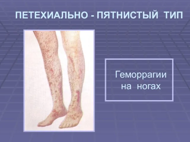 ПЕТЕХИАЛЬНО - ПЯТНИСТЫЙ ТИП Геморрагии на ногах