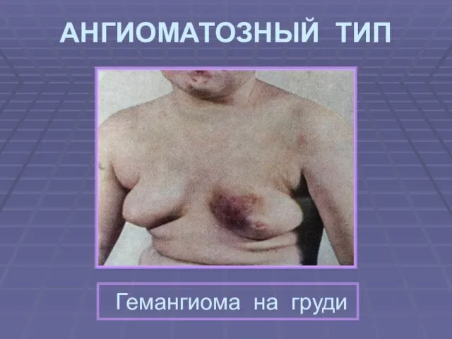 АНГИОМАТОЗНЫЙ ТИП Гемангиома на груди