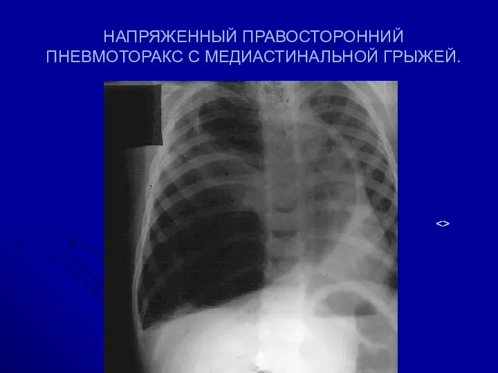 НАПРЯЖЕННЫЙ ПРАВОСТОРОННИЙ ПНЕВМОТОРАКС С МЕДИАСТИНАЛЬНОЙ ГРЫЖЕЙ.