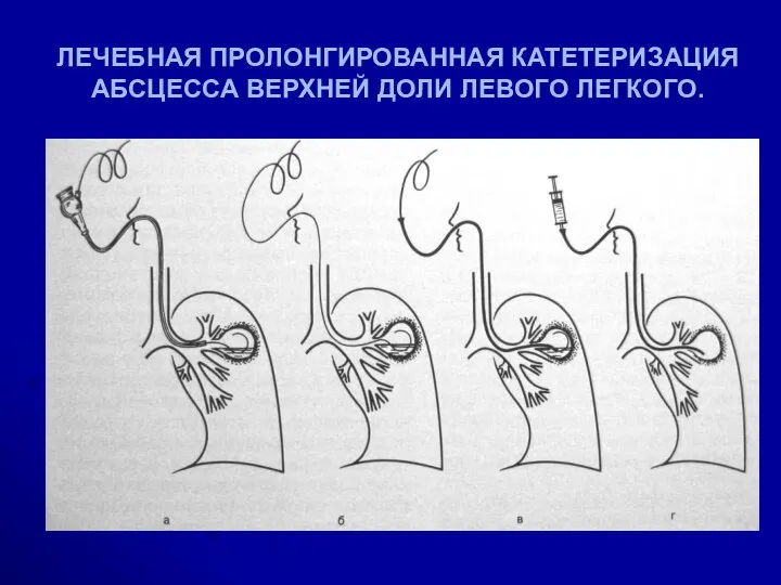 ЛЕЧЕБНАЯ ПРОЛОНГИРОВАННАЯ КАТЕТЕРИЗАЦИЯ АБСЦЕССА ВЕРХНЕЙ ДОЛИ ЛЕВОГО ЛЕГКОГО.