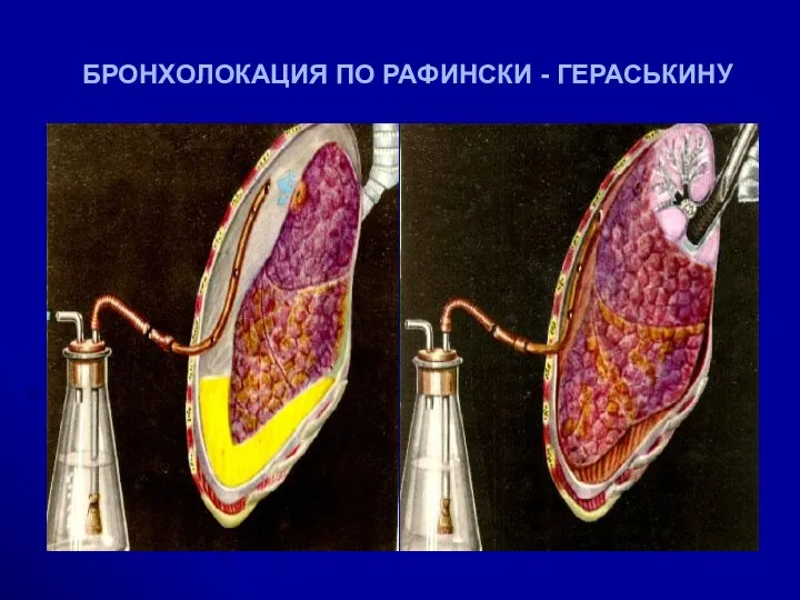 БРОНХОЛОКАЦИЯ ПО РАФИНСКИ - ГЕРАСЬКИНУ