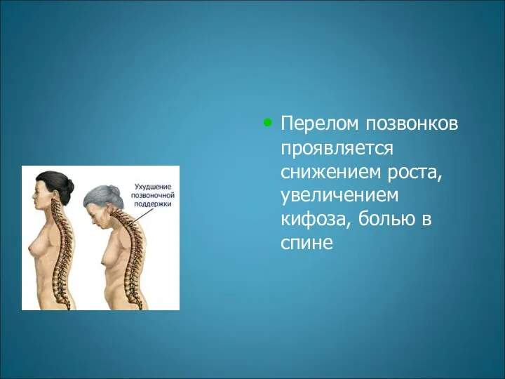 Перелом позвонков проявляется снижением роста, увеличением кифоза, болью в спине