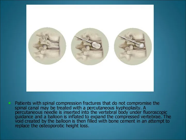 Patients with spinal compression fractures that do not compromise the spinal canal may