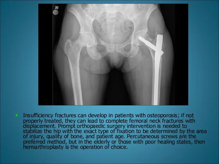 Insufficiency fractures can develop in patients with osteoporosis; if not properly treated, they
