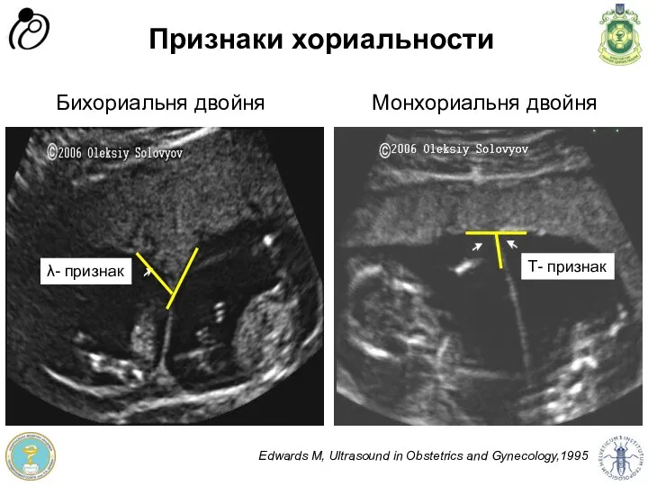 Признаки хориальности Бихориальня двойня Edwards M, Ultrasound in Obstetrics and