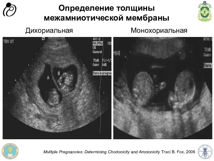 Определение толщины межамниотической мембраны Multiple Pregnancies: Determining Chorionicity and Amnionicity Traci B. Fox, 2006 Монохориальная Дихориальная