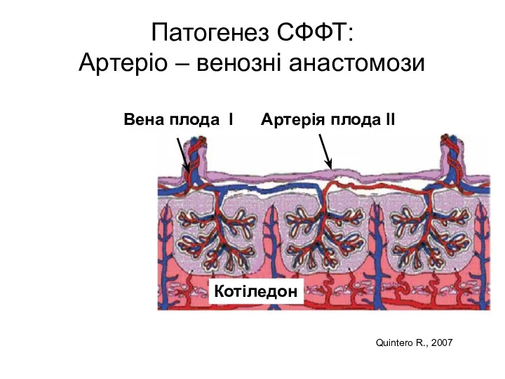 Патогенез СФФТ: Артеріо – венозні анастомози Артерія плода II Вена плода I Котіледон Quintero R., 2007