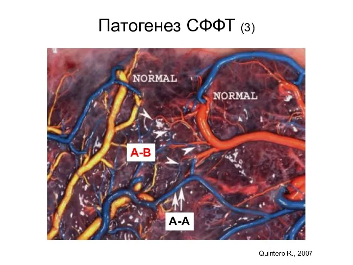 Патогенез СФФТ (3) А-А А-В Quintero R., 2007