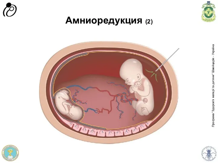 Амниоредукция (2)