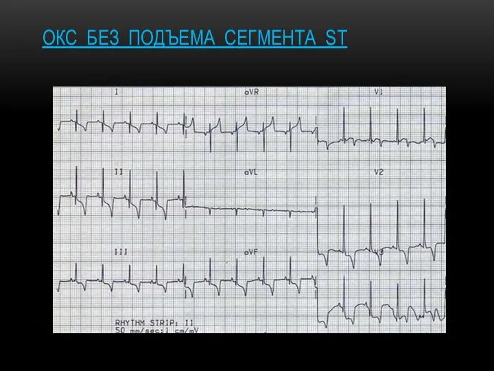 ОКС БЕЗ ПОДЪЕМА СЕГМЕНТА ST