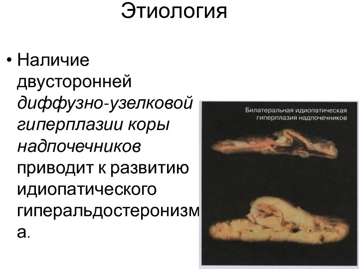 Этиология Наличие двусторонней диффузно-узелковой гиперплазии коры надпочечников приводит к развитию идиопатического гиперальдостеронизма.