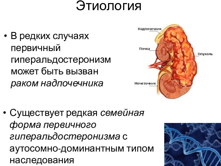 Этиология В редких случаях первичный гиперальдостеронизм может быть вызван раком надпочечника Существует редкая