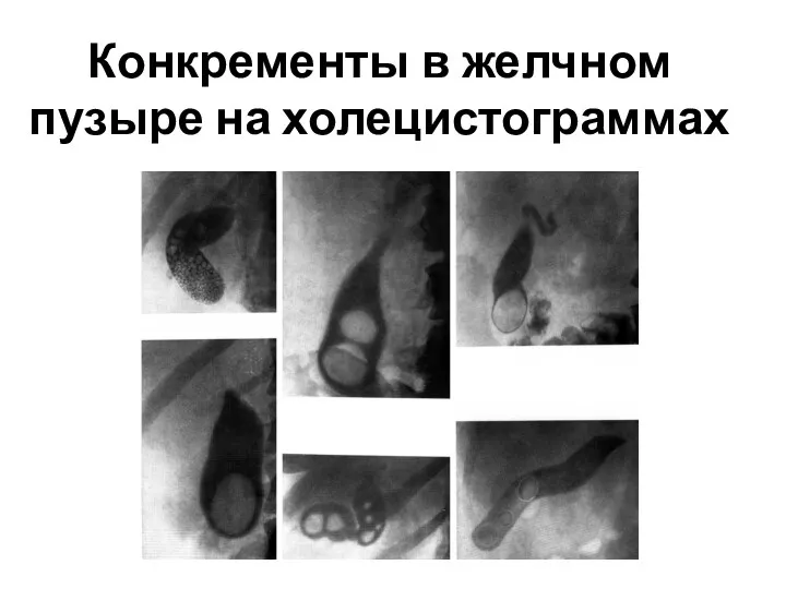 Конкременты в желчном пузыре на холецистограммах