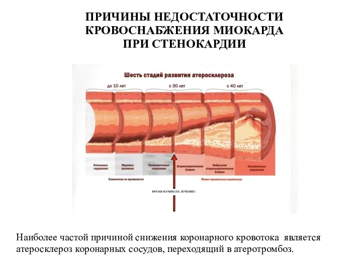 ПРИЧИНЫ НЕДОСТАТОЧНОСТИ КРОВОСНАБЖЕНИЯ МИОКАРДА ПРИ СТЕНОКАРДИИ Наиболее частой причиной снижения