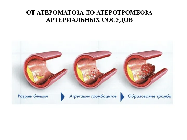 ОТ АТЕРОМАТОЗА ДО АТЕРОТРОМБОЗА АРТЕРИАЛЬНЫХ СОСУДОВ