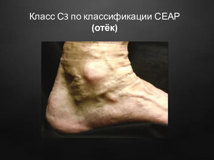 Класс С3 по классификации СЕАР (отёк)