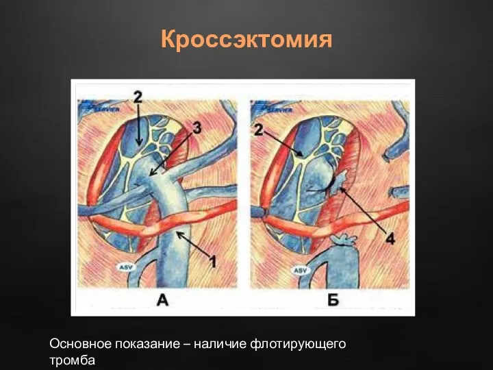 Кроссэктомия Основное показание – наличие флотирующего тромба