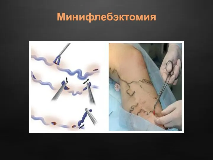 Минифлебэктомия