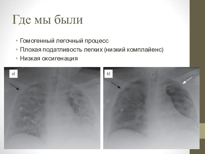 Где мы были Гомогенный легочный процесс Плохая податливость легких (низкий комплайенс) Низкая оксигенация