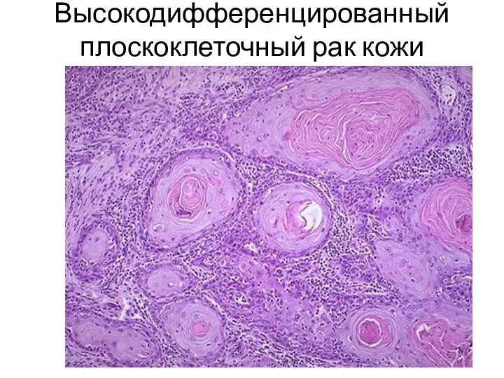 Высокодифференцированный плоскоклеточный рак кожи