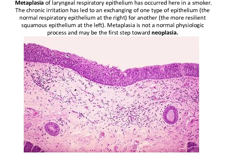 Metaplasia of laryngeal respiratory epithelium has occurred here in a