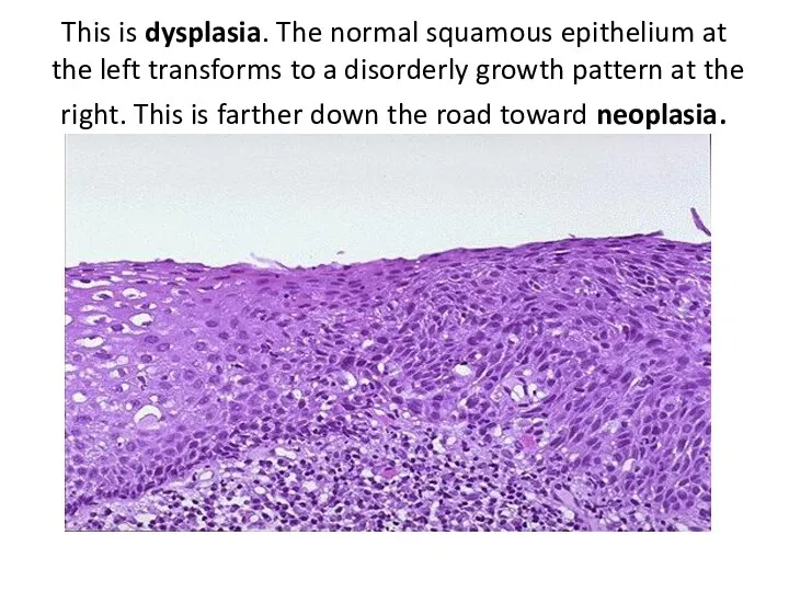 This is dysplasia. The normal squamous epithelium at the left